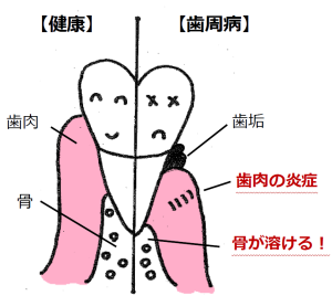歯周病の歯